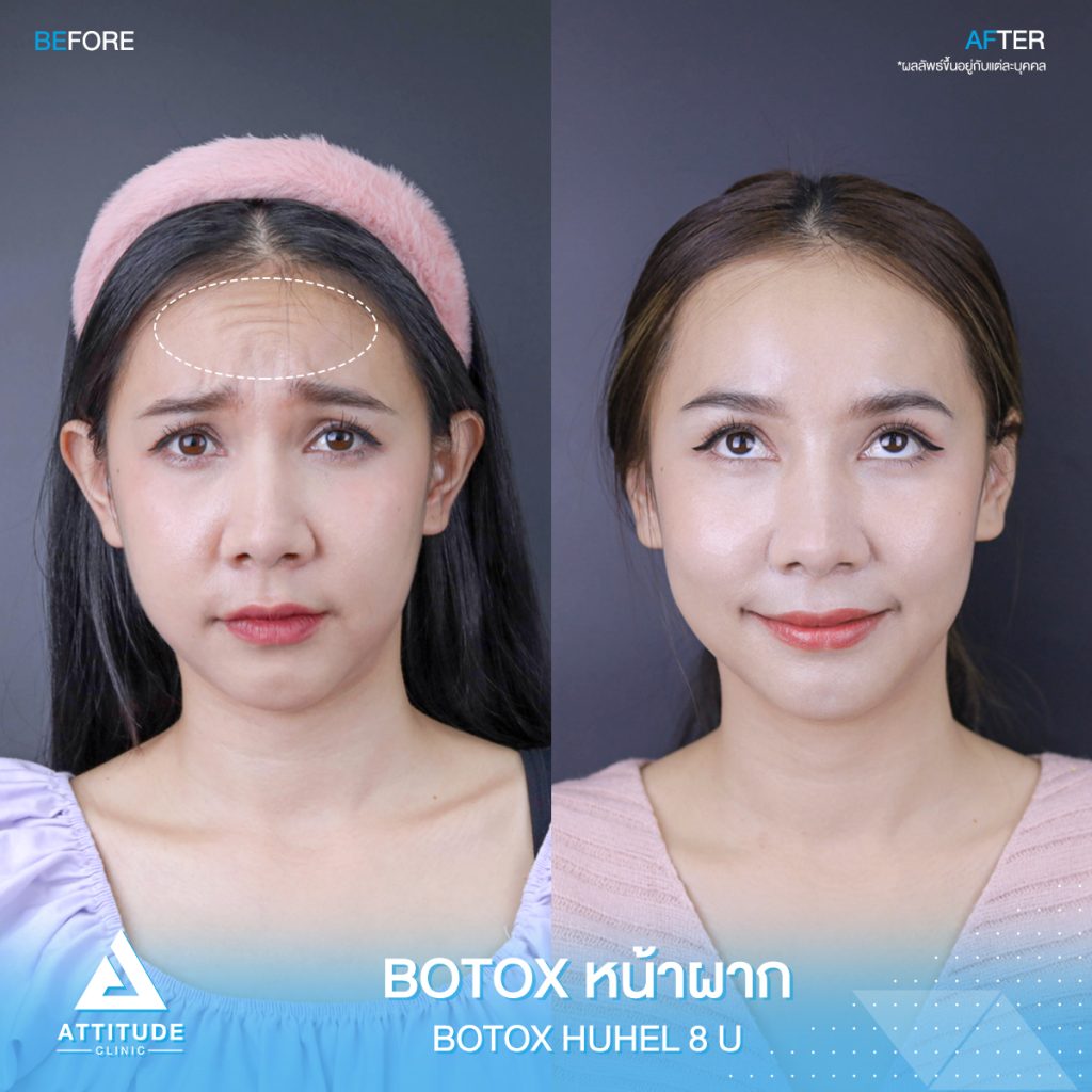 รีวิวฉีดโบท็อกซ์ลดริ้วรอย Upper Face 40 ยูนิต ด้วย Botox Hugelโบท็อกซ์เกาหลี บริเวณหน้าผาก ขมวดคิ้ว ตีนกา และใต้ตา ของคุณกุ๊บกิ๊บ ที่ Attitude Clinic เชียงราย เชียงใหม่ ลำปาง หมออยู่ทุกวัน ทำเองทุกเคส