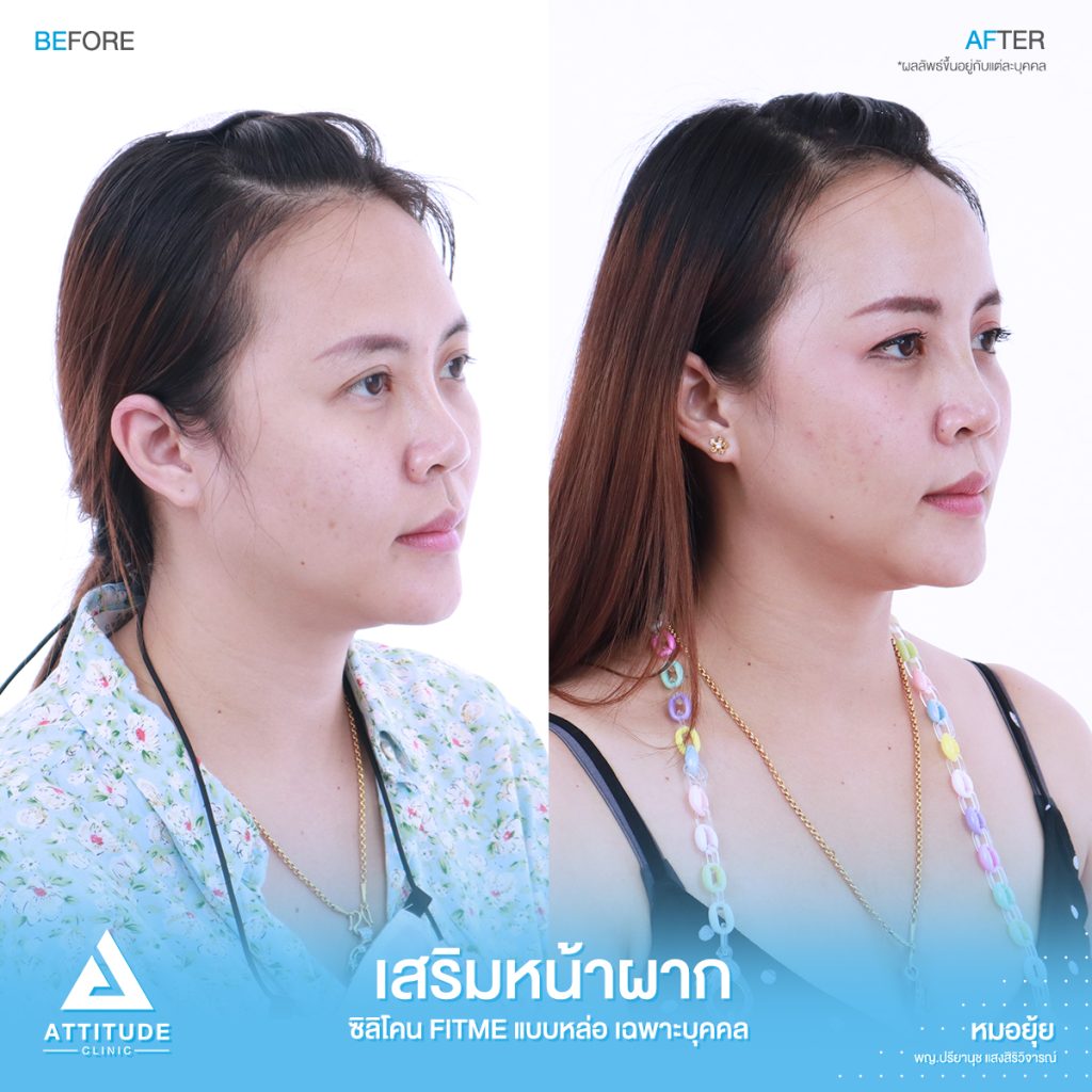 รีวิวเสริมหน้าผากคุณบูม ด้วยซิลิโคน Fitme แบบหล่อเฉพาะบุคคล ปรับรูปหน้าเติมเต็มจุดที่บุ๋มยุบ อย่างธรรมชาติ โดยคุณหมอยุ้ย Attitude Clinic รัชดา
