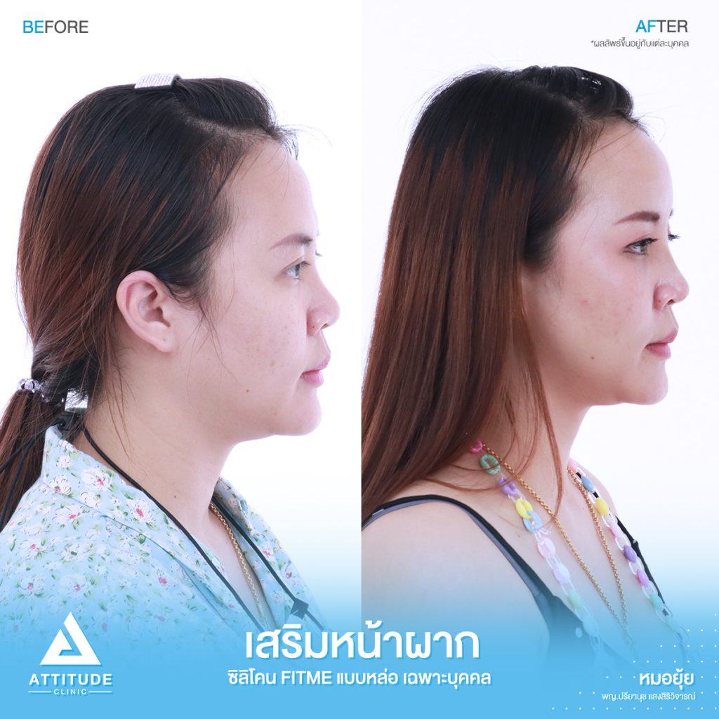 รีวิวเสริมหน้าผากคุณบูม ด้วยซิลิโคน Fitme แบบหล่อเฉพาะบุคคล  ปรับรูปหน้าเติมเต็มจุดที่บุ๋มยุบ อย่างธรรมชาติ โดยคุณหมอยุ้ย Attitude Clinic รัชดา