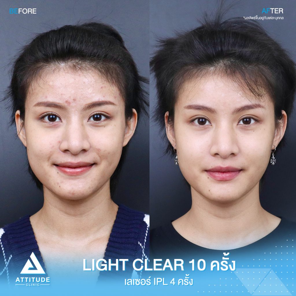 รีวิวรักษาสิวครบวงจร โปรแกรม Light Clear ด้วยการฉายแสง 7 ขั้นตอน จำนวน 10 ครั้ง และ เลเซอร์หน้าใส Cellec V IPL จำนวน 4 ครั้ง ของคุณญาดา ที่มีปัญหาสิวอุดตัน สิวอักเสบสิว สิวฮอร์โมน และรอยแดงจากสิว