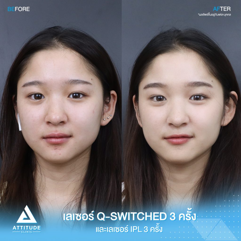 รีวิวการรักษาด้วยเลเซอร์ Q-switched 3 ครั้ง เลเซอร์ Cellec V IPL 3 ครั้ง ของน้องอาย มีปัญหารอยแดงจากสิว รูขุมขนกว้าง attitude clinic หมออยู่ทุกวัน ทำเองทุกเคส รีวิวเยอะที่สุด