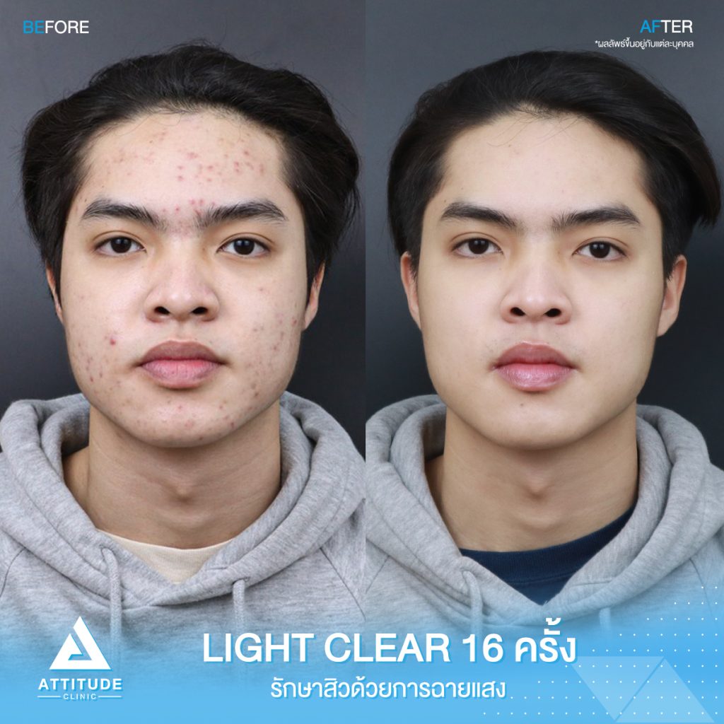 รีวิวรักษาสิวครบวงจร โปรแกรม Light Clear ด้วยการฉายแสง ? ขั้นตอน จำนวน 16 ครั้ง ของคุณกาฟิว ที่มีปัญหาสิวอุดตัน สิวอักเสบสิว สิวหัวหนอง สิวฮอร์โมน และรอยแดงจากสิว Attitude Clinic รักษาสิวเชียงใหม่ เชียงราย ลำปาง