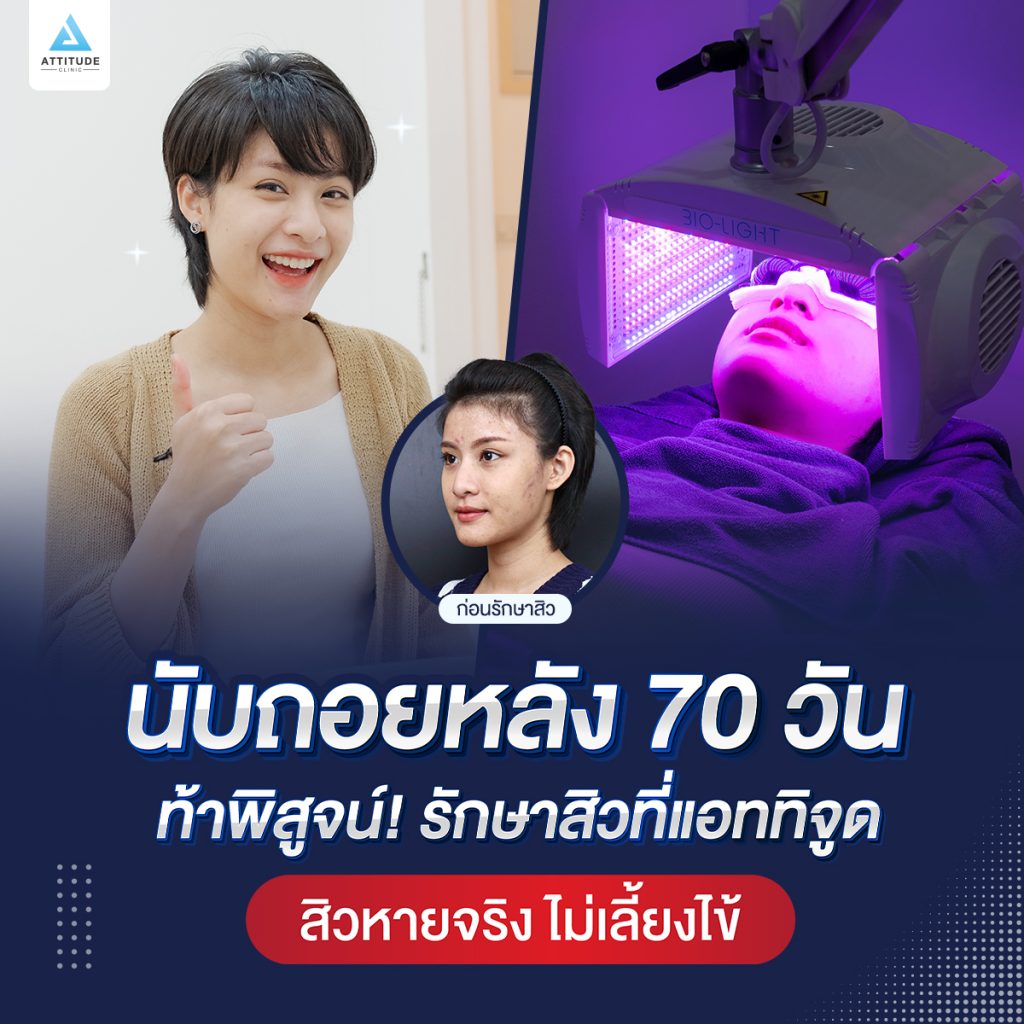 คลิปรีวิวรักษาสิว สิวหาย ไม่เลี้ยงไข้