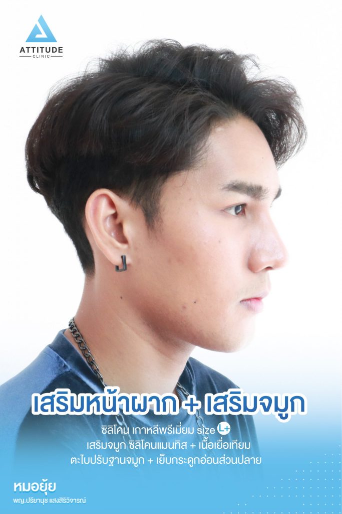 รีวิวเสริมหน้าผากผู้ชาย ด้วยซิลิโคนเกาหลีพรีเมี่ยม Size L+ และเสริมจมูกด้วยซิลิโคน Mantisk + เนื้อเยื่อเทียมปรับฐานจมูก และเย็บกกระดูกอ่อนส่วนปลาย โดยหมอยุ้ย Attitude Clinic รัชดา