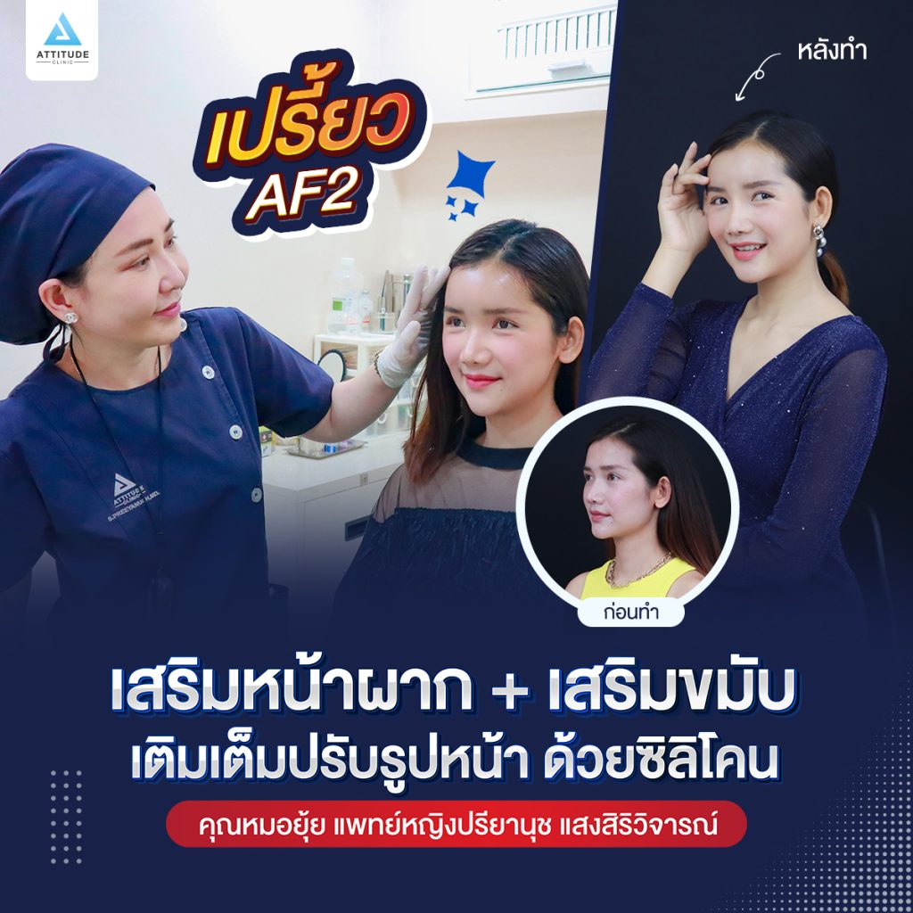 เปรี้ยว AF2 รีวิวเสริมหน้าผาก และเสริมขมับ