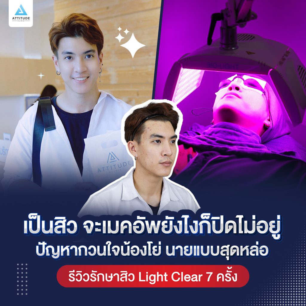 คลิปรีวิวรักษาสิวด้วยการฉายแสง จากหน้าสิวเป็นหน้าใสกิ๊ก แค่ 7 ครั้ง