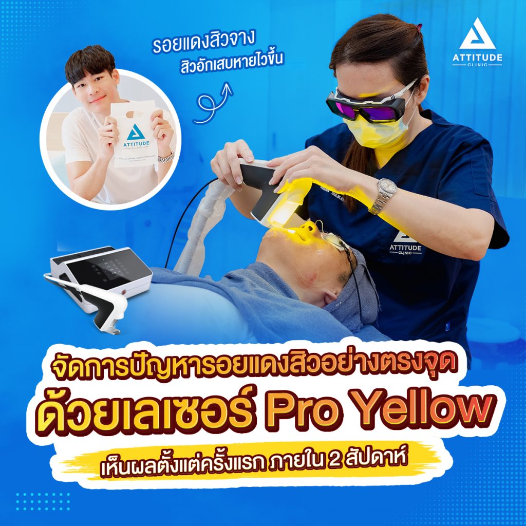 รีวิวเลเซอร์ลดรอยแดงจากสิว Pro Yellow