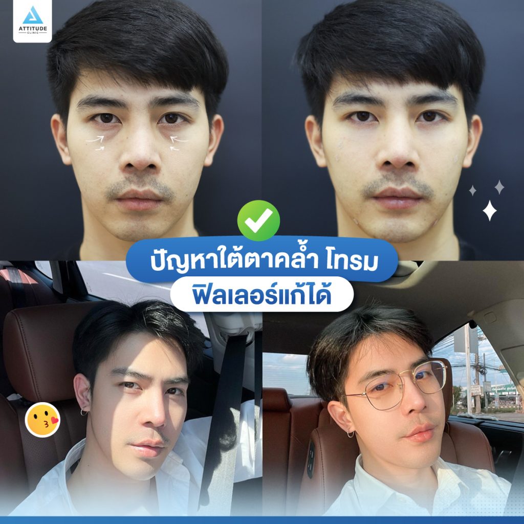 ปัญหาใต้ตาคล้ำ โทรม เป็นร่องชัด แก้ได้แค่เติมฟิลเลอร์ใต้ตา! ไม่ต้องผ่า ดูแลโดยคุณหมอผู้เชี่ยวชาญ ฟิลเลอร์คุณภาพ ช่วยคุณได้!!