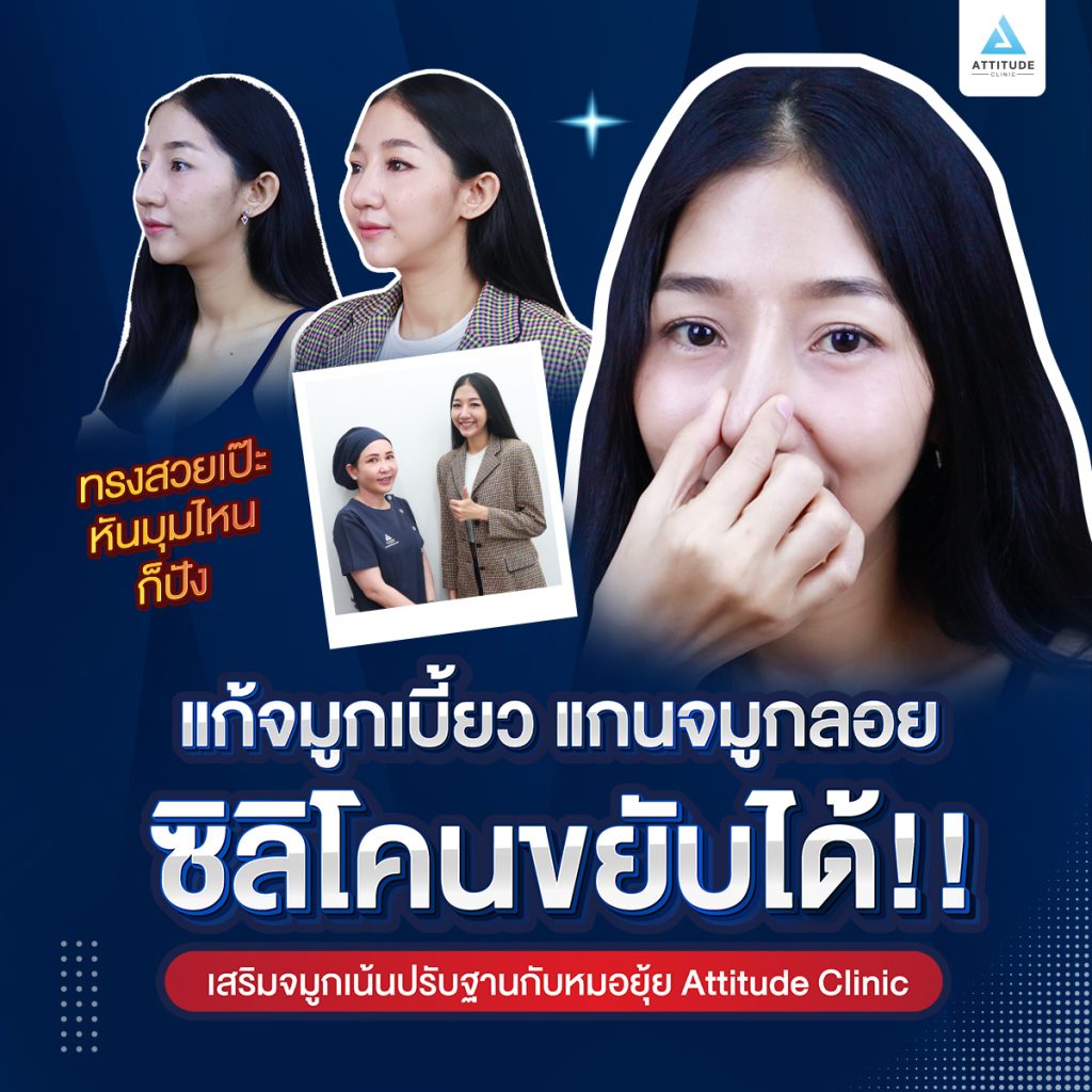 แก้ไขจมูก น้องมิ่ง หลังจากที่เคยเสริมจมูกแล้วเบี้ยวเอียง แก้ไขโดยคุณหมอยุ้ย attitude clinic