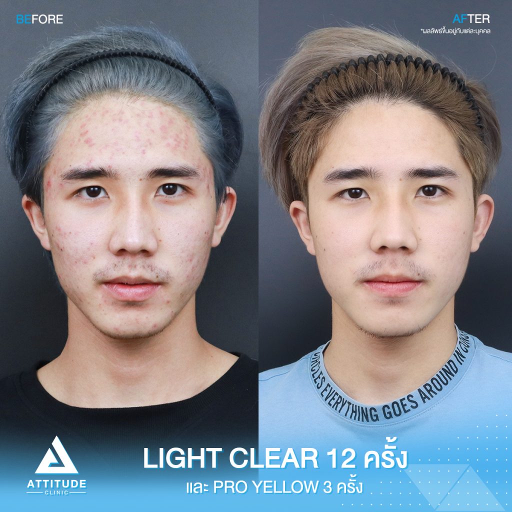 รีวิวรักษาสิวครบวงจร โปรแกรม Light Clear ฉายแสง 7 ขั้นตอน จำนวน 12 ครั้ง และเลเซอร์ Pro Yellow ลดรอยแดงโดยเฉพาะ จำนวน 3 ครั้ง ของน้องเอิร์ธ ที่มีปัญหาสิวอุดตัน สิวอักเสบ สิวฮอร์โมน และรอยแดงจากสิว หลังทำตอนนี้หน้าใส ไม่มีสิวใหม่ขึ้นแล้ว