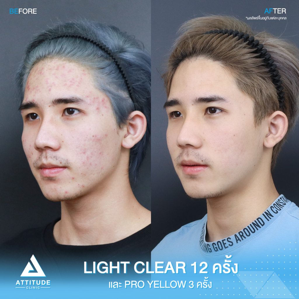 รีวิวรักษาสิวครบวงจร โปรแกรม Light Clear ฉายแสง 7 ขั้นตอน จำนวน 12 ครั้ง และเลเซอร์ Pro Yellow ลดรอยแดงโดยเฉพาะ จำนวน 3 ครั้ง ของน้องเอิร์ธ ที่มีปัญหาสิวอุดตัน สิวอักเสบ สิวฮอร์โมน และรอยแดงจากสิว หลังทำตอนนี้หน้าใส ไม่มีสิวใหม่ขึ้นแล้ว