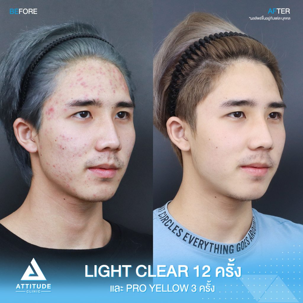 วิวรักษาสิวครบวงจร โปรแกรม Light Clear ฉายแสง 7 ขั้นตอน จำนวน 12 ครั้ง และเลเซอร์ Pro Yellow ลดรอยแดงโดยเฉพาะ จำนวน 3 ครั้ง ของน้องเอิร์ธ ที่มีปัญหาสิวอุดตัน สิวอักเสบ สิวฮอร์โมน และรอยแดงจากสิว หลังทำตอนนี้หน้าใส ไม่มีสิวใหม่ขึ้นแล้ว