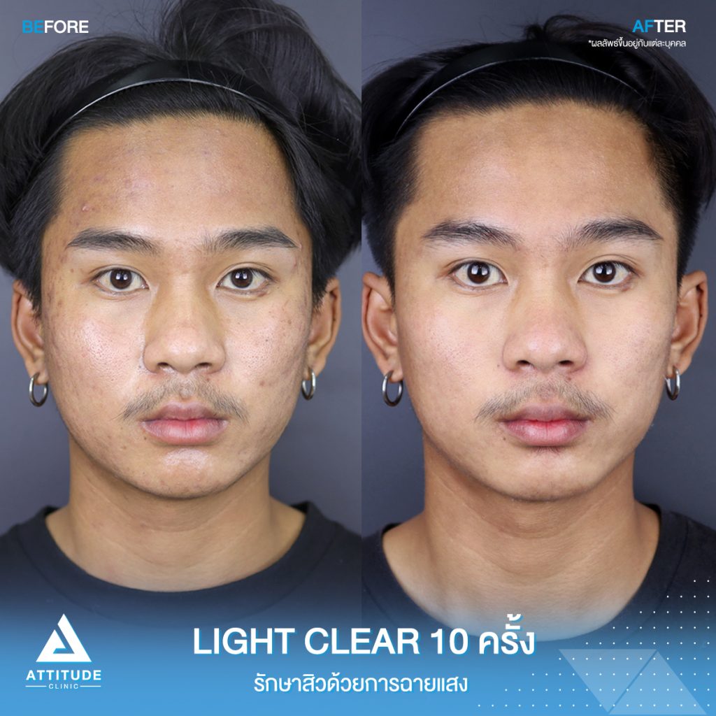 รีวิวรักษาสิวครบวงจร โปรแกรม Light Clear รักษาสิวด้วยการฉายแสง 7 ขั้นตอน จำนวน 10 ครั้ง ของน้องอชรายุ ที่มีปัญหาสิวอุดตัน สิวอักเสบ สิวฮอร์โมน และรอยแดงจากสิว