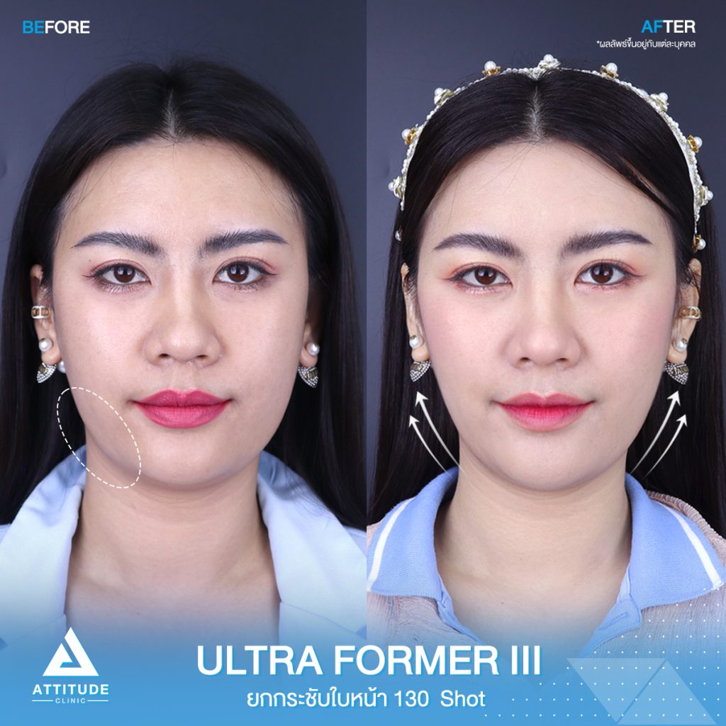 รีวิวยกกระชับใบหน้าด้วย Ultraformer III 130 Shot หลังทำทันที ของคุณเหมียว ที่มีปัญหาความหย่อนคล้อยบริเวณหน้าแก้ม ข้างแก้ม หลังทำหน้ายกกระชับขึ้น