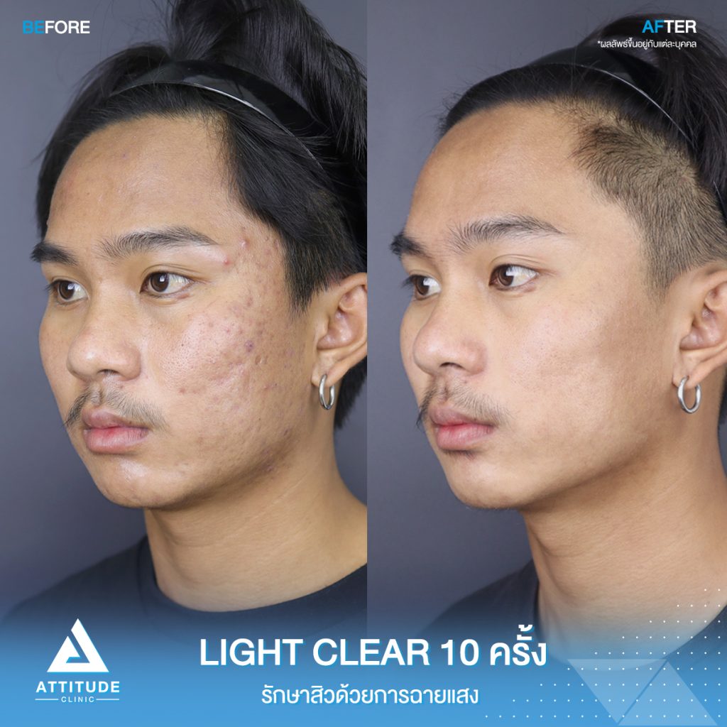 รีวิวรักษาสิวครบวงจร โปรแกรม Light Clear รักษาสิวด้วยการฉายแสง 7 ขั้นตอน จำนวน 10 ครั้ง ของน้องอชรายุ ที่มีปัญหาสิวอุดตัน สิวอักเสบ สิวฮอร์โมน และรอยแดงจากสิว