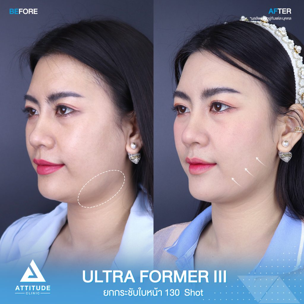 วิวยกกระชับใบหน้าด้วย Ultraformer III 130 Shot หลังทำทันที ของคุณเหมียว ที่มีปัญหาความหย่อนคล้อยบริเวณหน้าแก้ม ข้างแก้ม หลังทำหน้ายกกระชับขึ้น