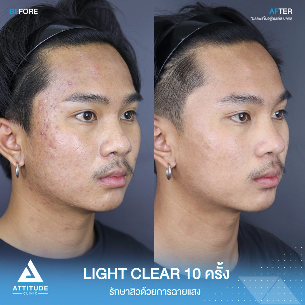 รีวิวรักษาสิวครบวงจร โปรแกรม Light Clear รักษาสิวด้วยการฉายแสง 7 ขั้นตอน จำนวน 10 ครั้ง ของน้องอชรายุ ที่มีปัญหาสิวอุดตัน สิวอักเสบ สิวฮอร์โมน และรอยแดงจากสิว