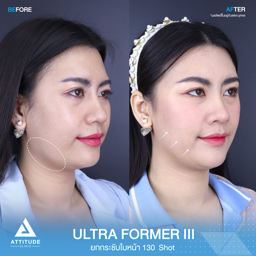 วิวยกกระชับใบหน้าด้วย Ultraformer III 130 Shot หลังทำทันที ของคุณเหมียว ที่มีปัญหาความหย่อนคล้อยบริเวณหน้าแก้ม ข้างแก้ม หลังทำหน้ายกกระชับขึ้น