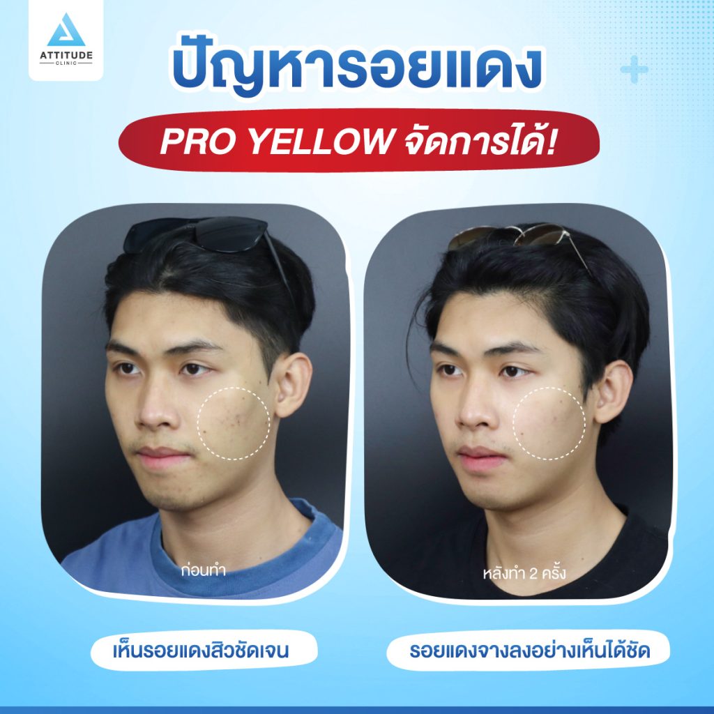 รู้อะไรไม่เท่ารู้งี้! ปัญหาหน้าหมองคล้ำ รอยแดงสิว สิวอักเสบ รักษาได้! ด้วยเลเซอร์ Pro Yellow ที่แอททิจูดคลินิก