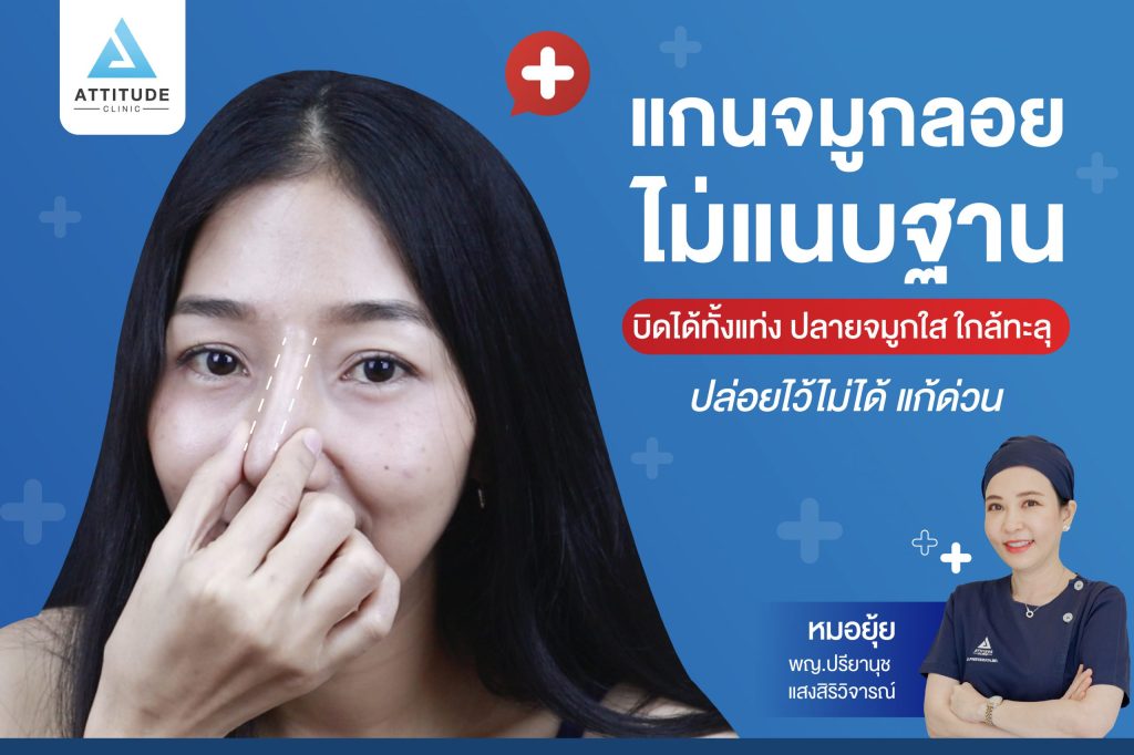 แกนจมูกลอยไม่แนบฐาน บิดได้ทั้งแท่ง ปลายจมูกใส ใกล้ทะลุ ปล่อยไว้ไม่ได้ เคสแก้จมูกกับหมอยุ้ย Attitude Clinic รัชดา