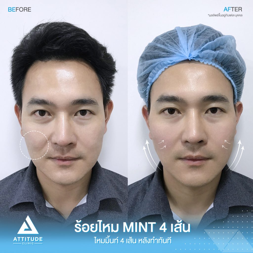 รีวิวร้อยไหมมิ้นท์ Mint Lift จำนวน 4 เส้น  ❝ ยก ตึง ดึง ล็อก ❞ ช่วงหน้าแก้มและร่องแก้ม ของคุณตี๋ ผู้บริหารแอททิจูด คลินิก