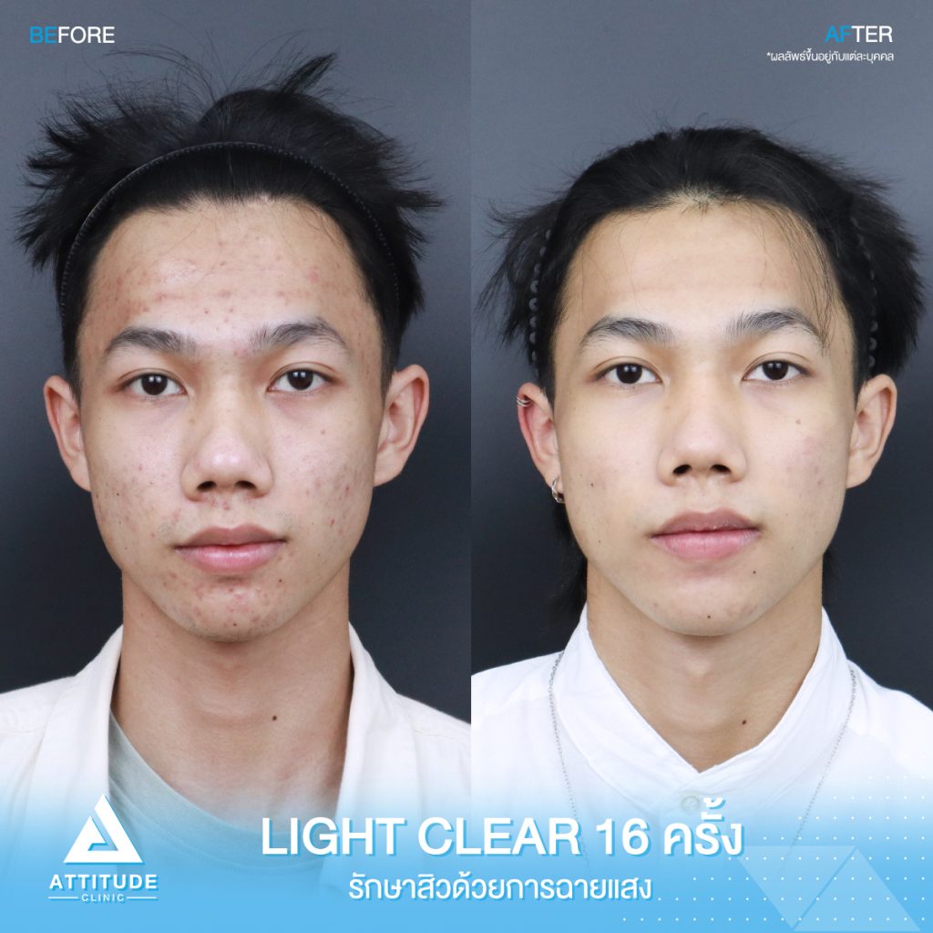 รีวิวรักษาสิวครบวงจร โปรแกรม Light Clear รักษาสิวด้วยการฉายแสง 7 ขั้นตอน จำนวน 16 ครั้ง ของน้องฟีฟ่า ที่มีปัญหาสิวอุดตัน สิวอักเสบ สิวฮอร์โมน และรอยแดงจากสิว