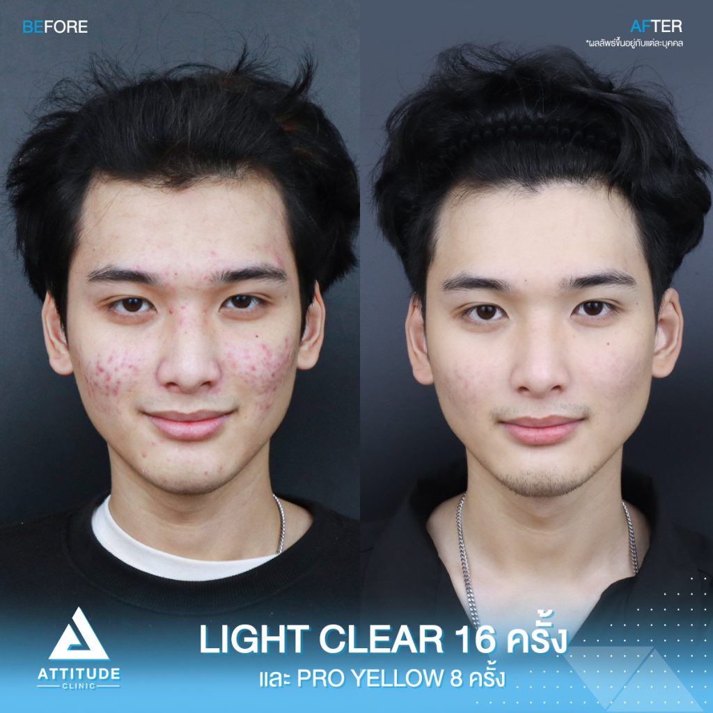 รีวิวรักษาสิวครบวงจร โปรแกรม Light Clear รักษาสิวด้วยการฉายแสง 7 ขั้นตอน จำนวน 16 ครั้ง และเลเซอร์ลดรอยแดงสิว Pro Yellow จำนวน 8 ครั้ง ของน้องแดท