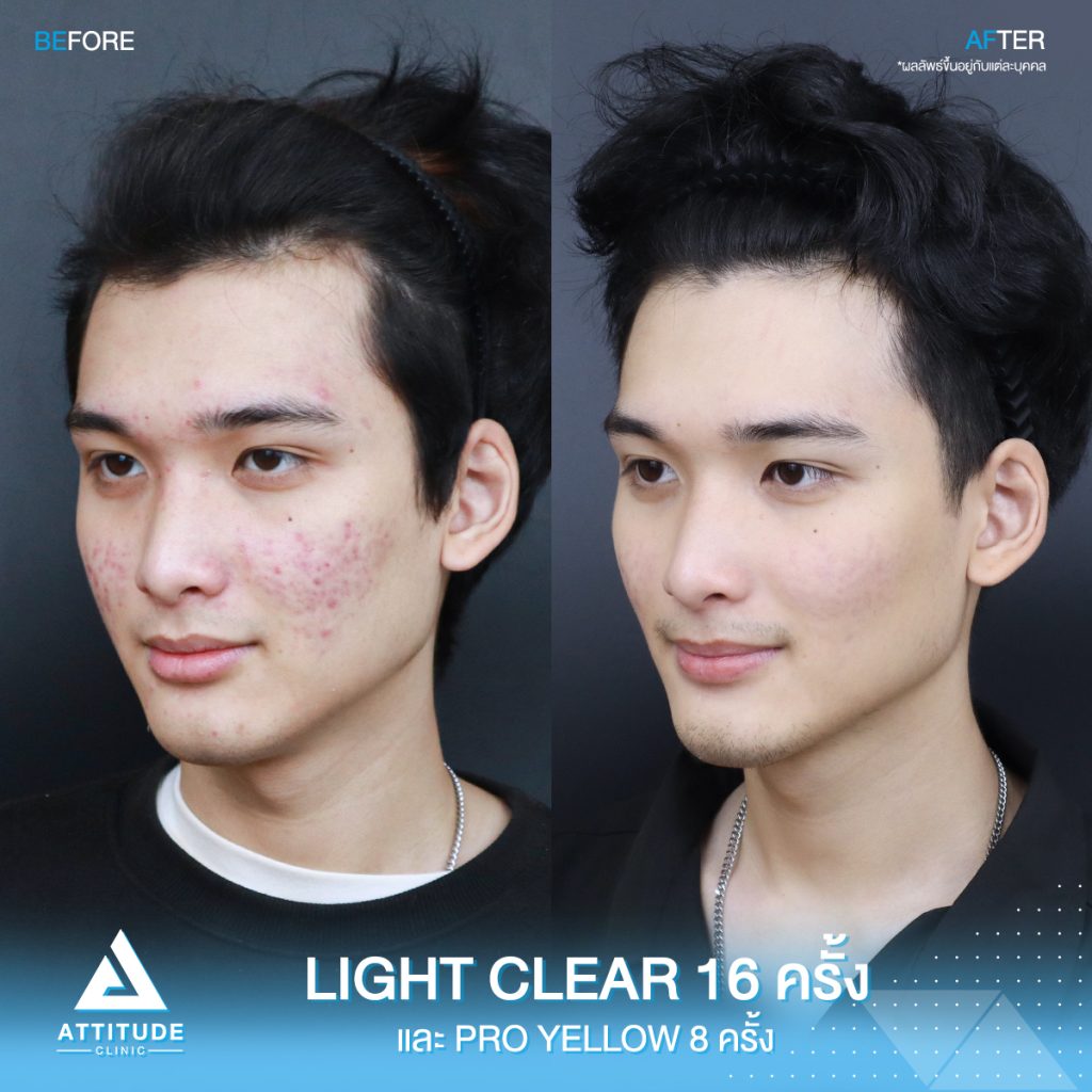 รีวิวรักษาสิวครบวงจร โปรแกรม Light Clear รักษาสิวด้วยการฉายแสง 7 ขั้นตอน จำนวน 16 ครั้ง และเลเซอร์ลดรอยแดงสิว Pro Yellow จำนวน 8 ครั้ง ของน้องแดท