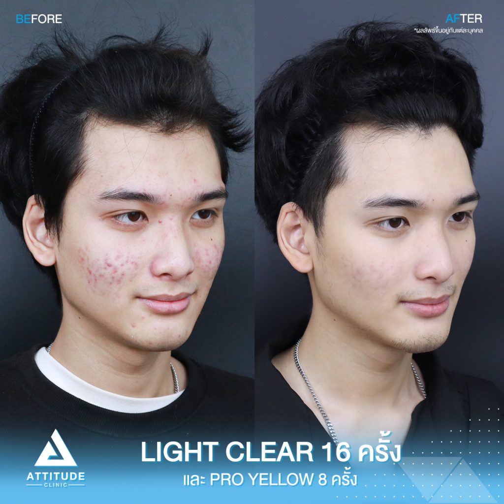 รีวิวรักษาสิวครบวงจร โปรแกรม Light Clear รักษาสิวด้วยการฉายแสง 7 ขั้นตอน จำนวน 16 ครั้ง และเลเซอร์ลดรอยแดงสิว Pro Yellow จำนวน 8 ครั้ง ของน้องแดท