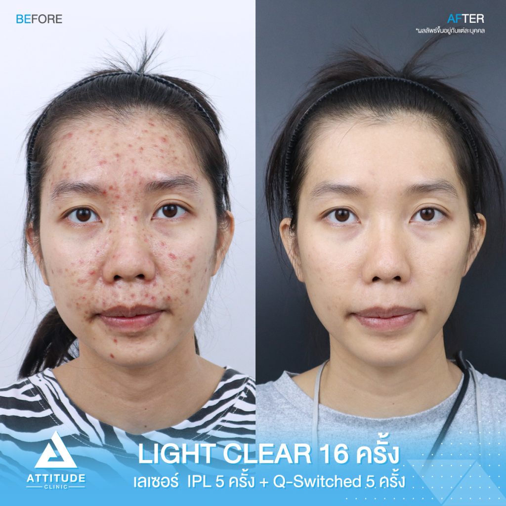 รีวิวรักษาสิวครบวงจร โปรแกรม Light Clear รักษาสิวด้วยการฉายแสง 7 ขั้นตอน จำนวน 16 ครั้ง เลเซอร์หน้าใส Cellec V IPL จำนวน 5 ครั้ง เลเซอร์ลดเม็ดสี Q-Switched จำนวน 5 ครั้ง ของน้องอุ๊