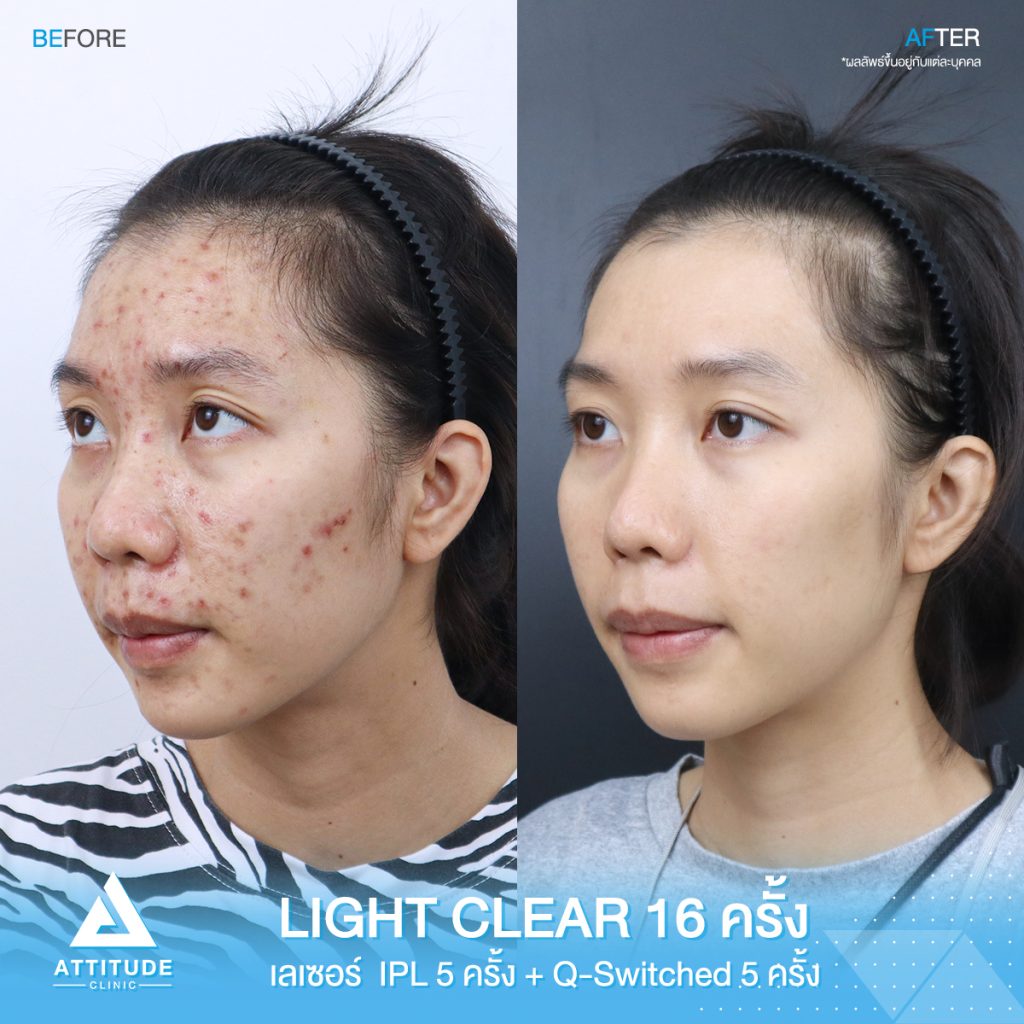 รีวิวรักษาสิวครบวงจร โปรแกรม Light Clear รักษาสิวด้วยการฉายแสง 7 ขั้นตอน จำนวน 16 ครั้ง เลเซอร์หน้าใส Cellec V IPL จำนวน 5 ครั้ง เลเซอร์ลดเม็ดสี Q-Switched จำนวน 5 ครั้ง ของน้องอุ๊