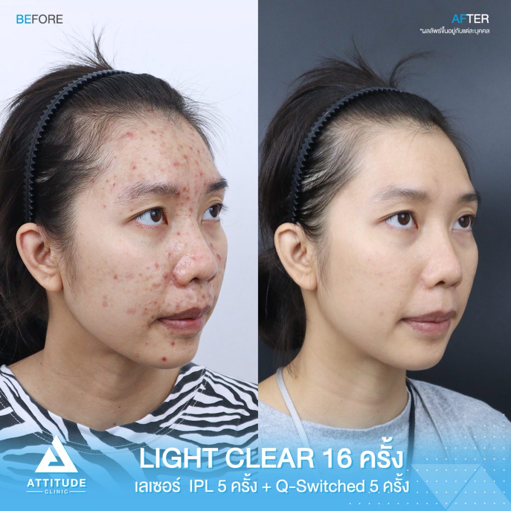 รีวิวรักษาสิวครบวงจร โปรแกรม Light Clear รักษาสิวด้วยการฉายแสง 7 ขั้นตอน จำนวน 16 ครั้ง เลเซอร์หน้าใส Cellec V IPL จำนวน 5 ครั้ง เลเซอร์ลดเม็ดสี Q-Switched จำนวน 5 ครั้ง ของน้องอุ๊