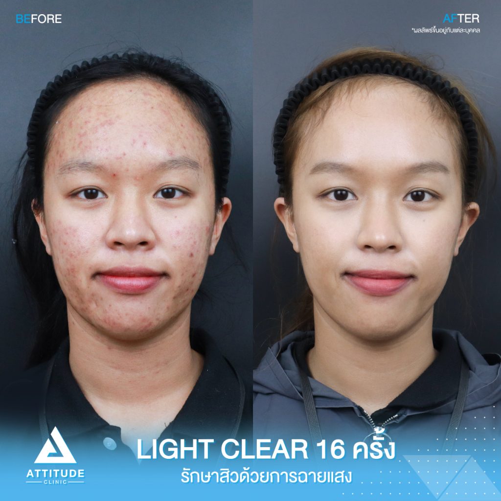 รีวิวรักษาสิวครบวงจร โปรแกรม Light Clear รักษาสิวด้วยการฉายแสง 7 ขั้นตอน จำนวน 16 ครั้ง ของน้องจุ๊บจิ๊บ ที่มีปัญหาสิวอุดตัน สิวอักเสบ สิวฮอร์โมน