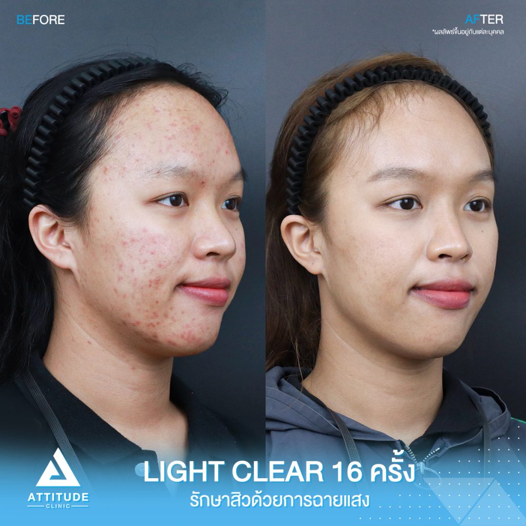 รีวิวรักษาสิวครบวงจร โปรแกรม Light Clear รักษาสิวด้วยการฉายแสง 7 ขั้นตอน จำนวน 16 ครั้ง ของน้องจุ๊บจิ๊บ ที่มีปัญหาสิวอุดตัน สิวอักเสบ สิวฮอร์โมน