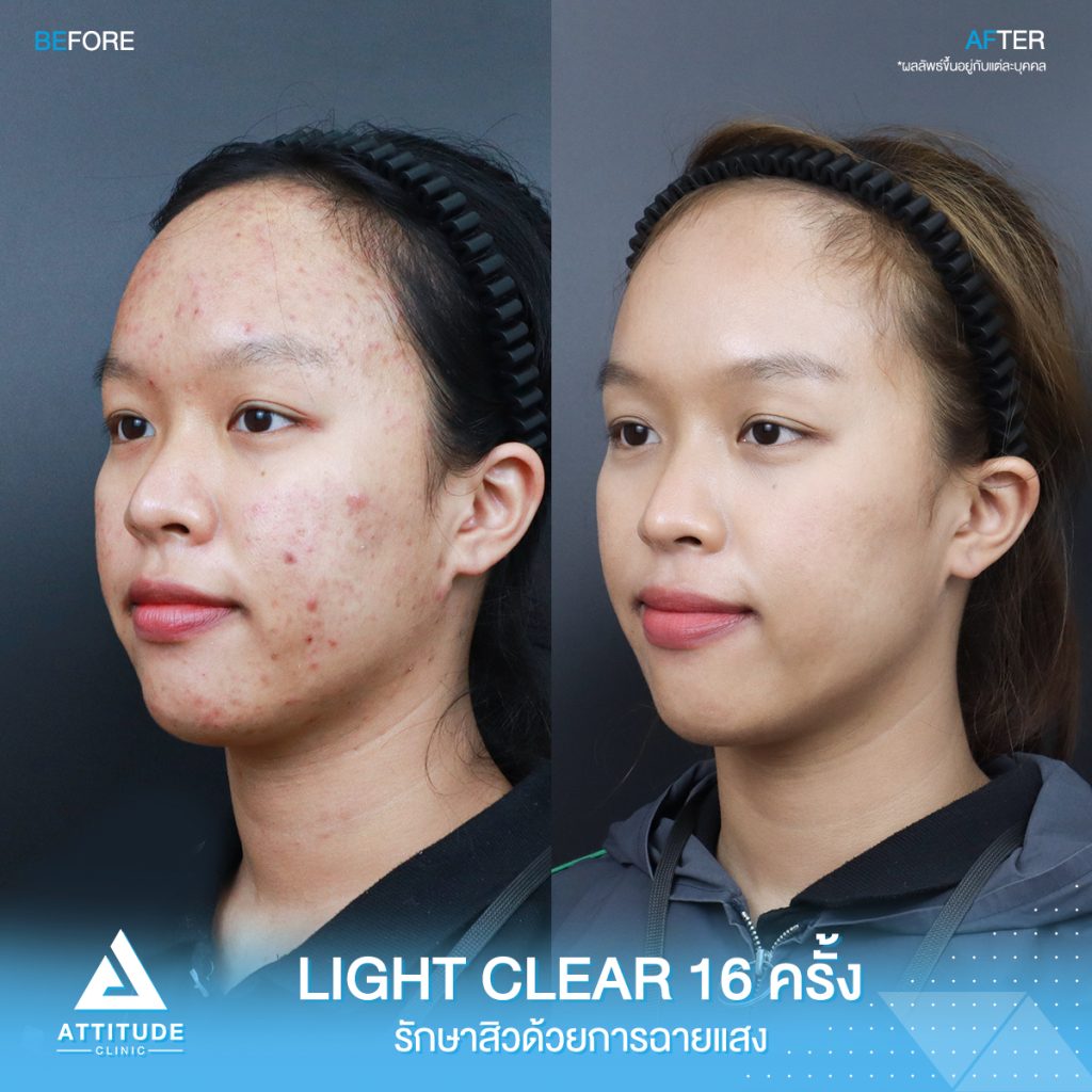 รีวิวรักษาสิวครบวงจร โปรแกรม Light Clear รักษาสิวด้วยการฉายแสง 7 ขั้นตอน จำนวน 16 ครั้ง ของน้องจุ๊บจิ๊บ ที่มีปัญหาสิวอุดตัน สิวอักเสบ สิวฮอร์โมน