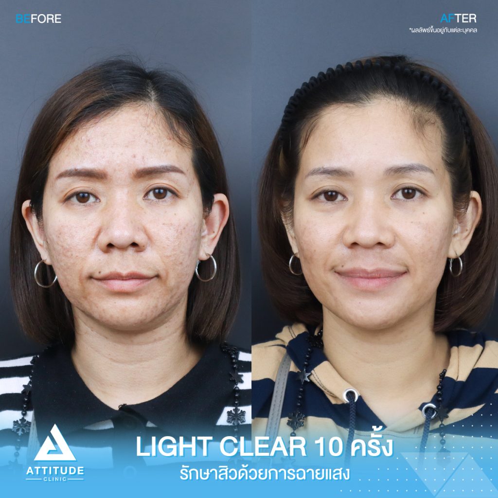 รีวิวรักษาสิวครบวงจรคุณโป โปรแกรม Light Clear ด้วยการฉายแสง 7 ขั้นตอน จำนวน 10 ครั้ง ที่มีปัญหาสิวอุดตัน สิวผด สิวแพ้ และรอยแดงจากสิวที่ Attitude Clinic