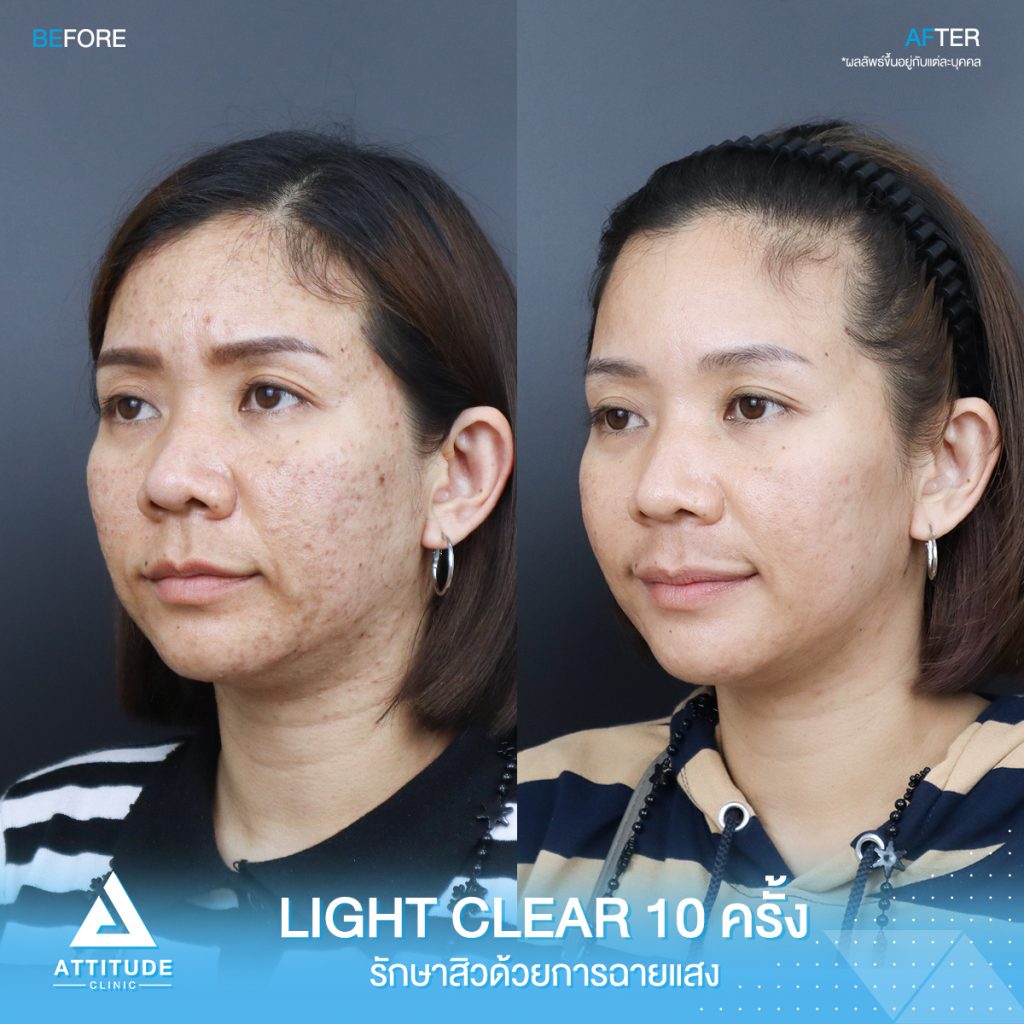 รีวิวรักษาสิวครบวงจรคุณโป โปรแกรม Light Clear ด้วยการฉายแสง 7 ขั้นตอน จำนวน 10 ครั้ง ที่มีปัญหาสิวอุดตัน สิวผด สิวแพ้ และรอยแดงจากสิวที่ Attitude Clinic