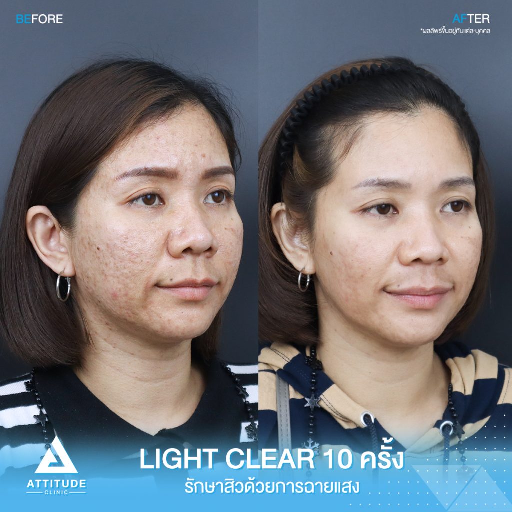 รีวิวรักษาสิวครบวงจรคุณโป โปรแกรม Light Clear ด้วยการฉายแสง 7 ขั้นตอน จำนวน 10 ครั้ง ที่มีปัญหาสิวอุดตัน สิวผด สิวแพ้ และรอยแดงจากสิวที่ Attitude Clinic