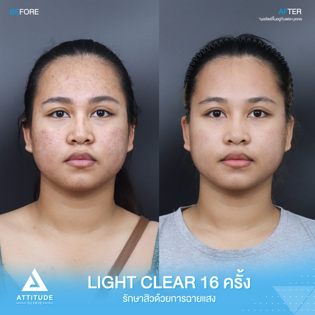 รีวิวรักษาสิวครบวงจร โปรแกรม Light Clear ด้วยการฉายแสง 7 ขั้นตอน จำนวน 16 ครั้ง ของน้องโบแดง ที่มีปัญหาสิวอุดตัน สิวอักเสบสิว สิวฮอร์โมน และรอยแดงจากสิว