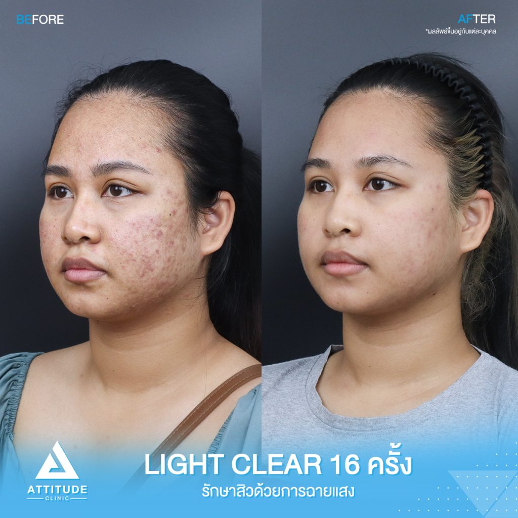 รีวิวรักษาสิวครบวงจร โปรแกรม Light Clear ด้วยการฉายแสง 7 ขั้นตอน จำนวน 16 ครั้ง ของน้องโบแดง ที่มีปัญหาสิวอุดตัน สิวอักเสบสิว สิวฮอร์โมน และรอยแดงจากสิว