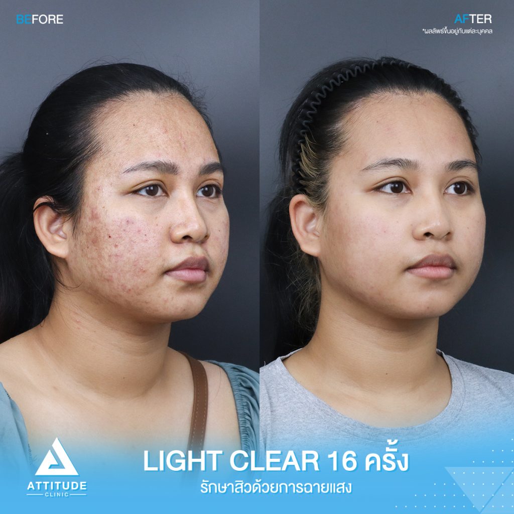 รีวิวรักษาสิวครบวงจร โปรแกรม Light Clear ด้วยการฉายแสง 7 ขั้นตอน จำนวน 16 ครั้ง ของน้องโบแดง ที่มีปัญหาสิวอุดตัน สิวอักเสบสิว สิวฮอร์โมน และรอยแดงจากสิว