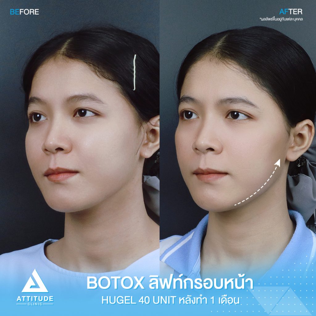 รีวิวฉีดโบท็อกซ์ลิฟท์กรอบหน้า จำนวน 40 ยูนิต ของคุณอ้อ หลังฉีด 1 เดือน ด้วยโบท็อกซ์ Hugel โบท็อกซ์เกาหลีที่ Attitude Clinic