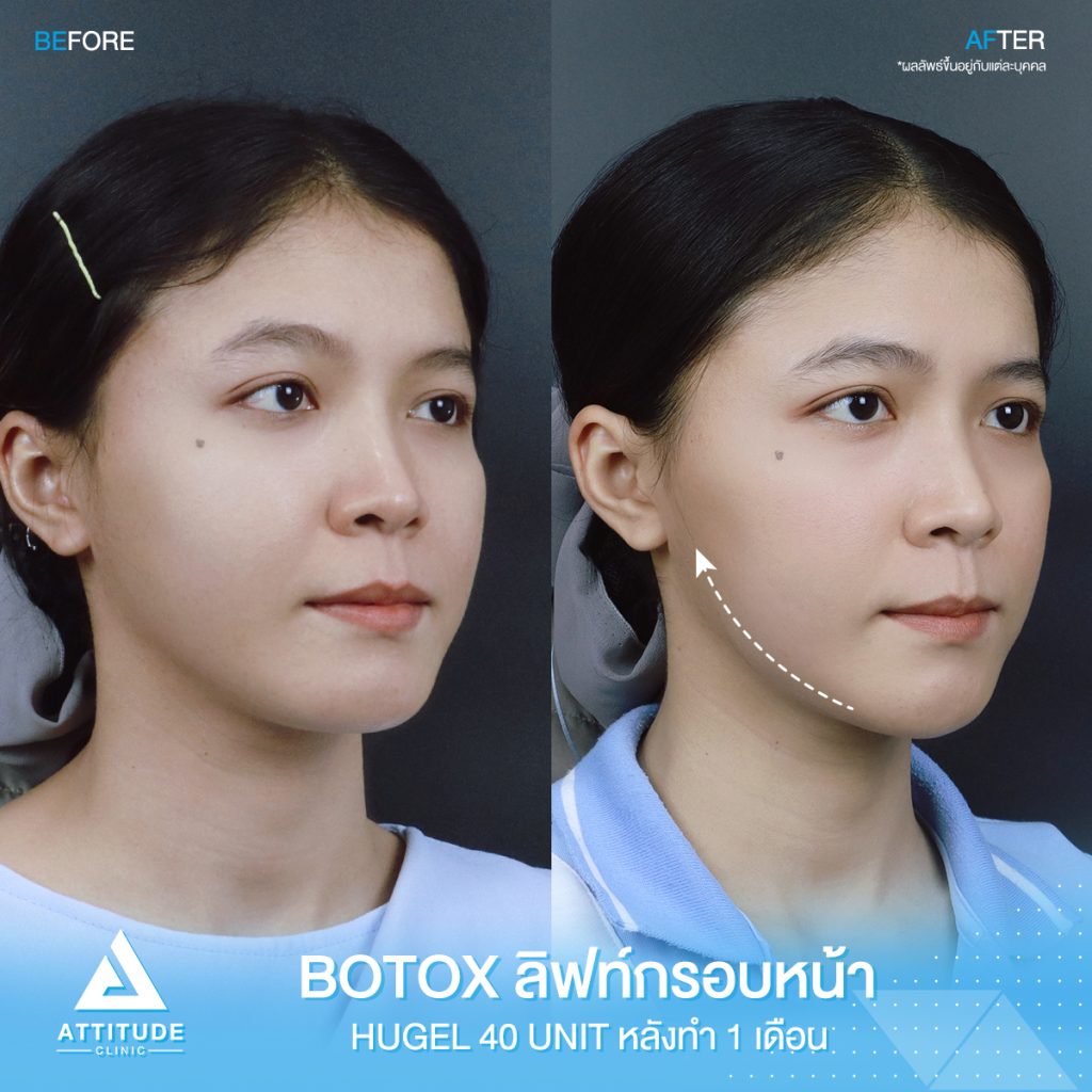 รีวิวฉีดโบท็อกซ์ลิฟท์กรอบหน้า จำนวน 40 ยูนิต ของคุณอ้อ หลังฉีด 1 เดือน ด้วยโบท็อกซ์ Hugel โบท็อกซ์เกาหลีที่ Attitude Clinic