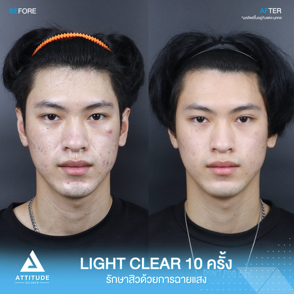 รีวิวรักษาสิวครบวงจร โปรแกรม Light Clear ด้วยการฉายแสง 7 ขั้นตอน จำนวน 10 ครั้ง ของน้องคอม ที่มีปัญหาสิวอุดตัน สิวอักเสบสิว สิวฮอร์โมน และรอยแดงจากสิว