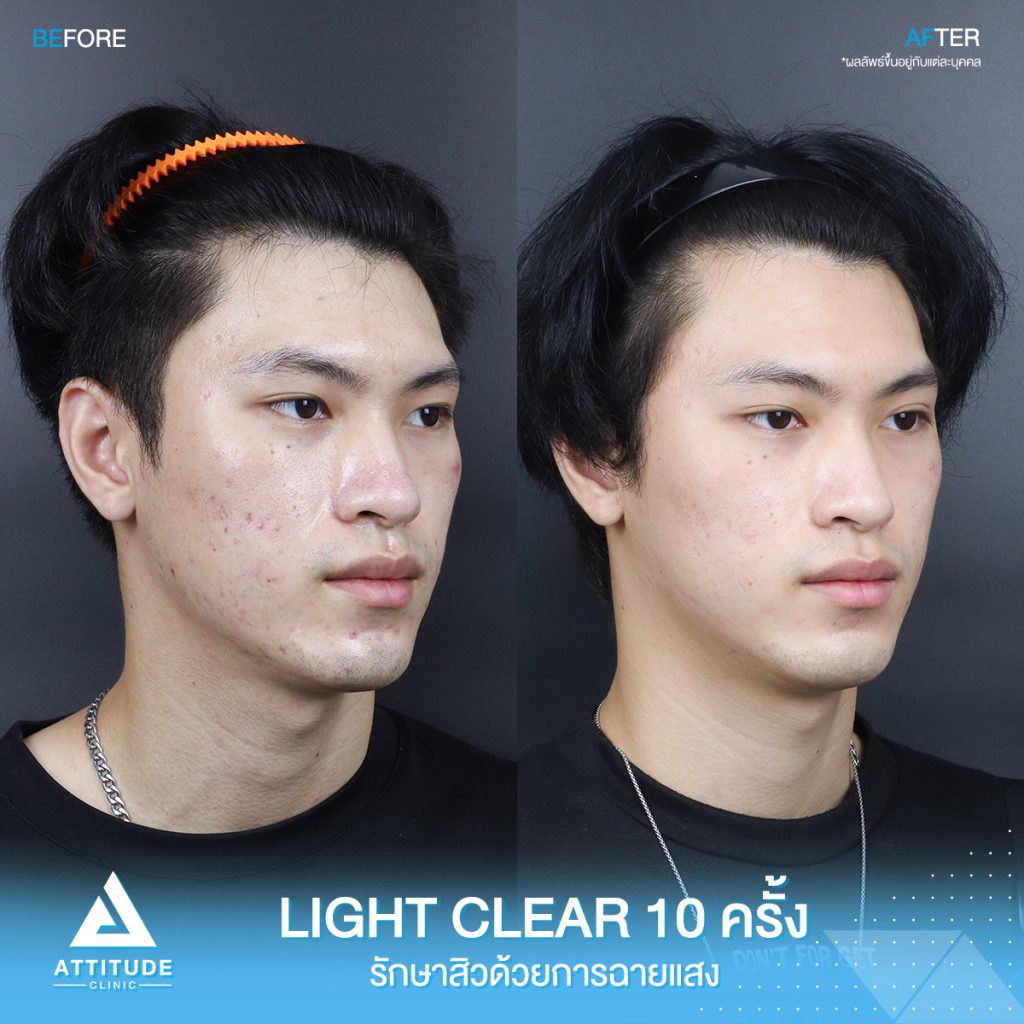 รีวิวรักษาสิวครบวงจร โปรแกรม Light Clear ด้วยการฉายแสง 7 ขั้นตอน จำนวน 10 ครั้ง ของน้องคอม ที่มีปัญหาสิวอุดตัน สิวอักเสบสิว สิวฮอร์โมน และรอยแดงจากสิว