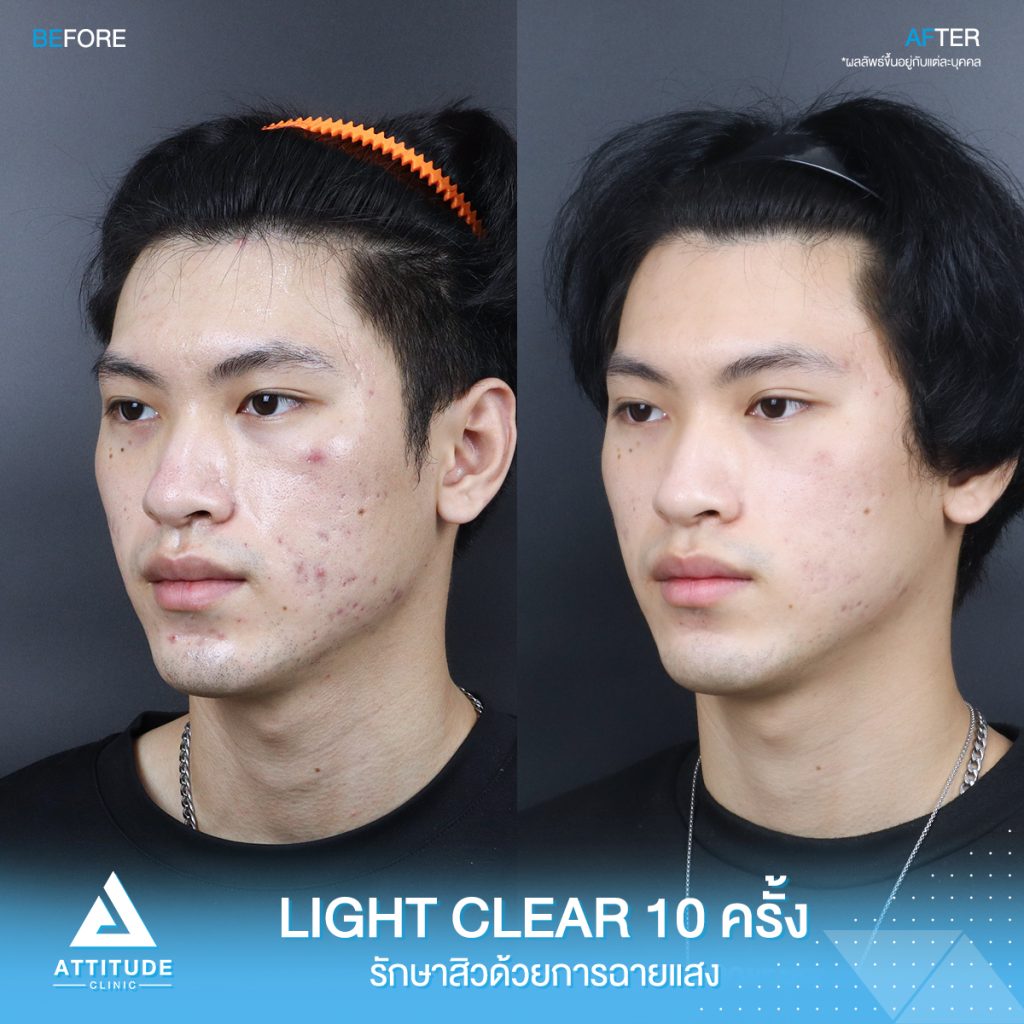 รีวิวรักษาสิวครบวงจร โปรแกรม Light Clear ด้วยการฉายแสง 7 ขั้นตอน จำนวน 10 ครั้ง ของน้องคอม ที่มีปัญหาสิวอุดตัน สิวอักเสบสิว สิวฮอร์โมน และรอยแดงจากสิว