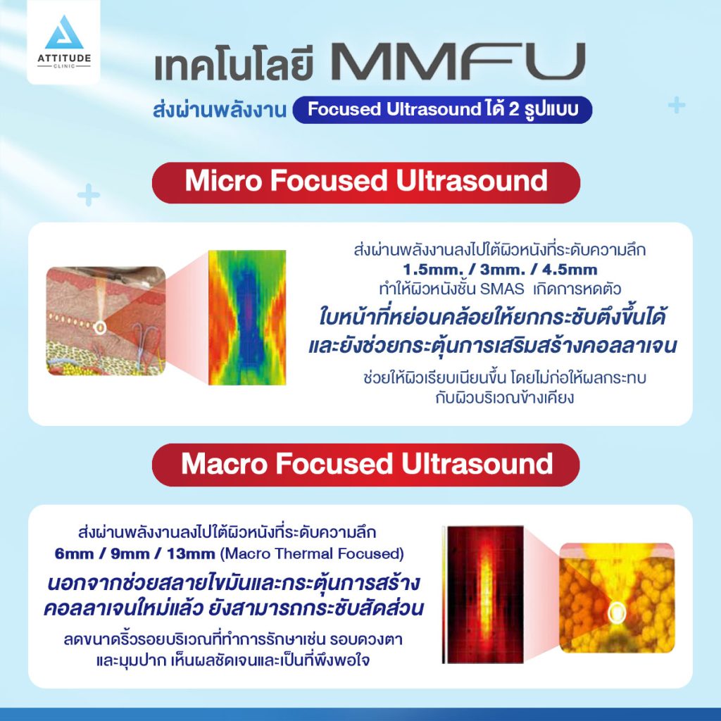 ทำไมถึงยกให้ Ultraformer lll ดีกว่า เห็นผลมากกว่า Hifu ทั่วไป ถึง 5 เท่า