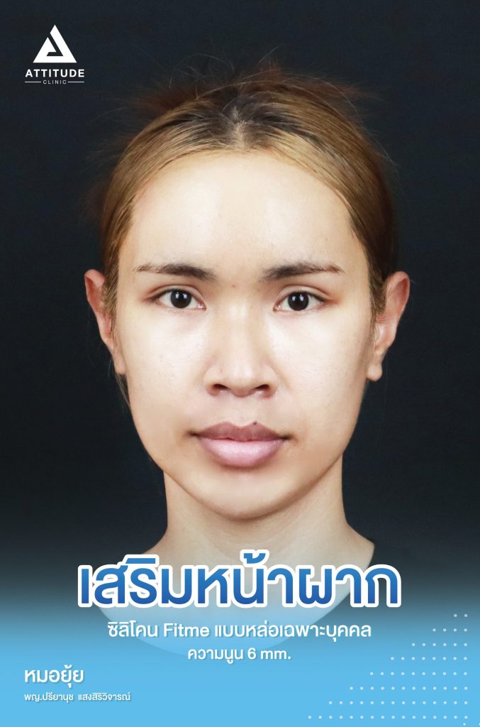 รีวิวเสริมหน้าผากคุณกระต่าย ด้วยซิลิโคน Fitme แบบหล่อเฉพาะบุคคล แก้ปัญหาหน้าผากยุบตัวลงเป็นแอ่ง เห็นโหนกคิ้วกระดูกชัด หน้าดุไม่หวานละมุน เติมเต็มให้สวย แบบถาวร โดยคุณหมอยุ้ย