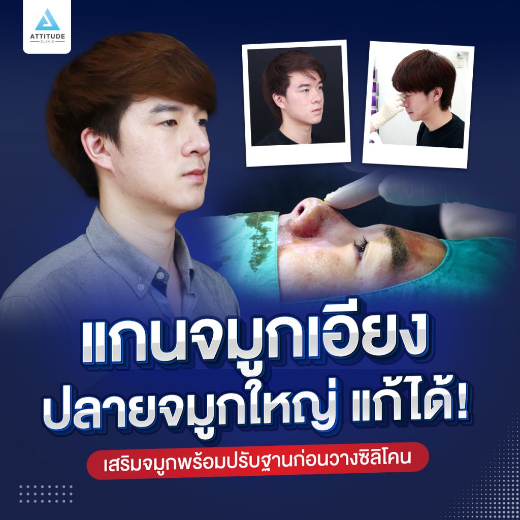 รีวิวเสริมจมูกผู้ชาย แก้ปัญหาแกนจมูกเอียง ปลายจมูกใหญ่