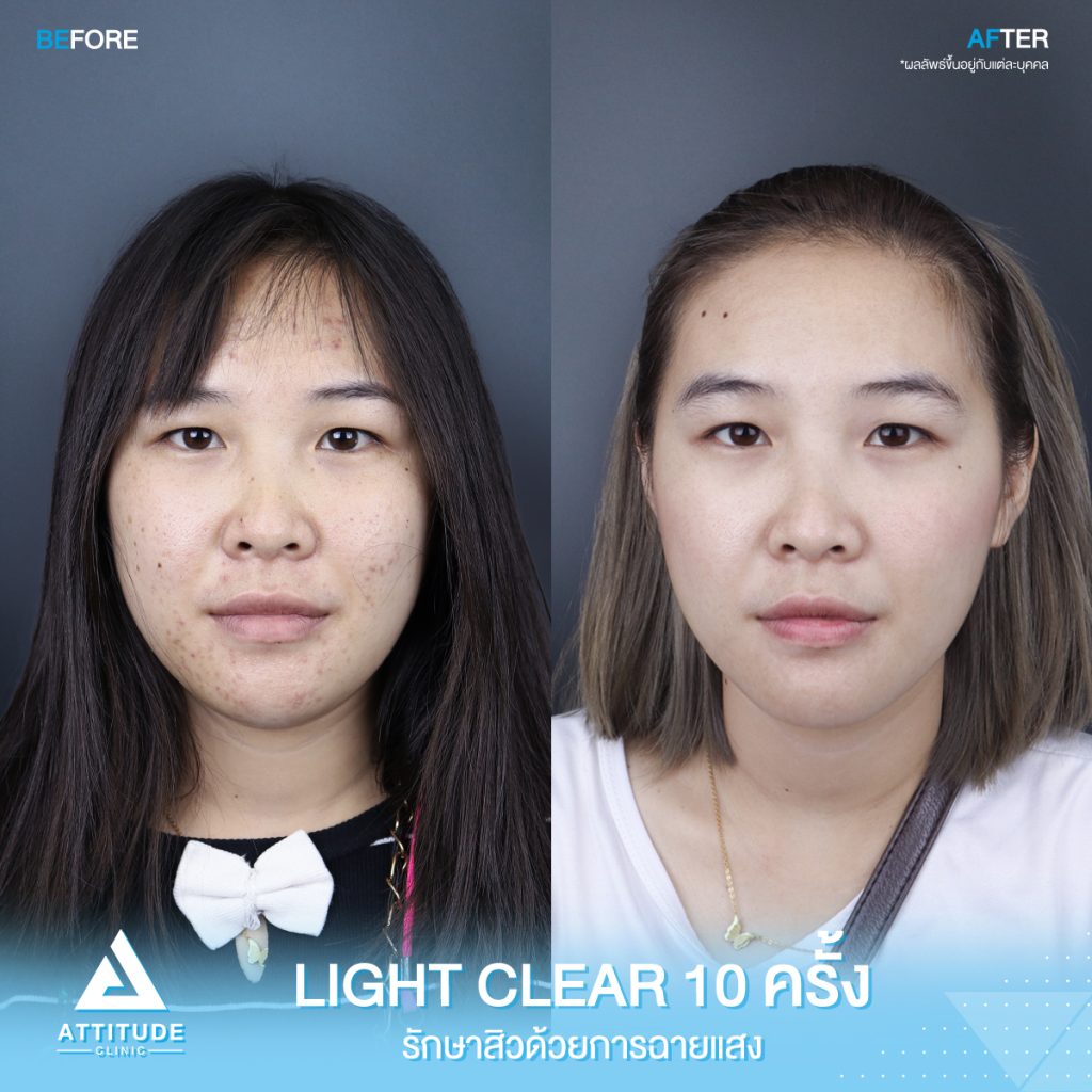 รีวิวรักษาสิวครบวงจร โปรแกรม Light Clear ด้วยการฉายแสง 7 ขั้นตอน จำนวน 10 ครั้ง ของน้องภานุกุล ที่มีปัญหาสิวอุดตัน สิวอักเสบสิว สิวฮอร์โมนและรอยแดงจากสิว